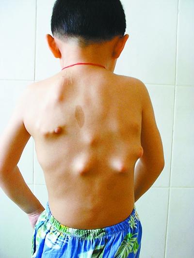 14岁男孩脊柱侧弯33度半有脚撇是怎么回事,还