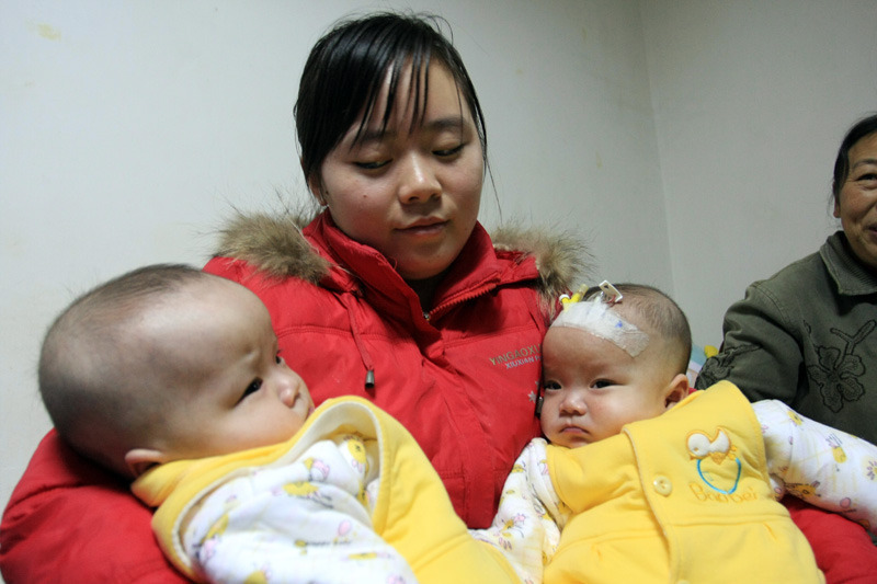 中国首例坐骨连体婴儿分离手术在武汉成功完成