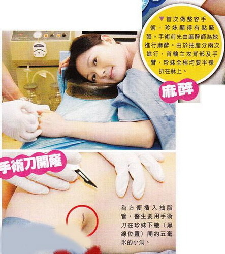44岁李丽珍抽脂照曝光