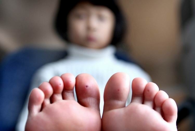 小脚丫 小女孩在酒店的水池里玩耍后,双脚的脚指头上都出现了小洞洞
