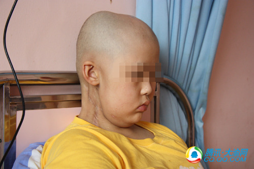 重庆医科大学附属儿童医院肿瘤外科的孩子