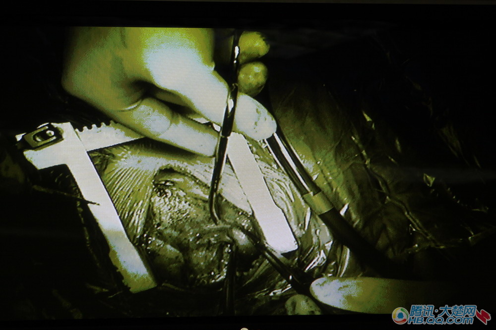 万千网友关注 双胞胎小兄弟手术顺利结束(图)