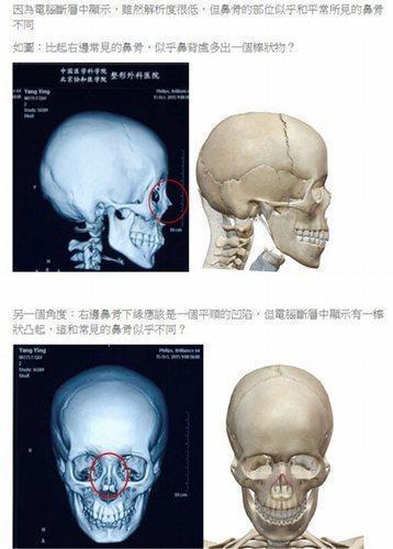 专家质疑baby整容鉴定结果:鼻骨有异样凸起物