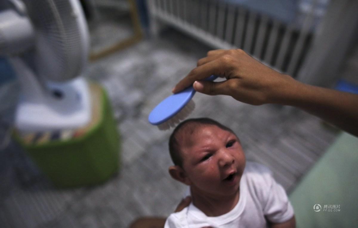 巴西寨卡病毒肆虐下的小头症宝宝