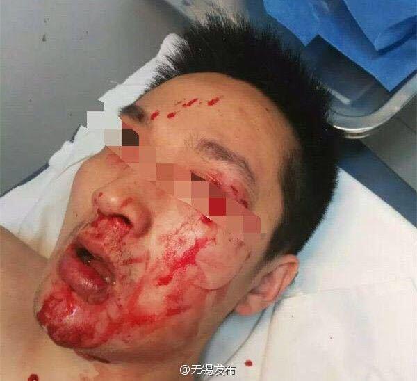 江苏无锡市一医院医生被堵门殴打 面部多处出血