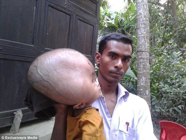孟加拉两岁男孩患脑积水 头部重18斤
