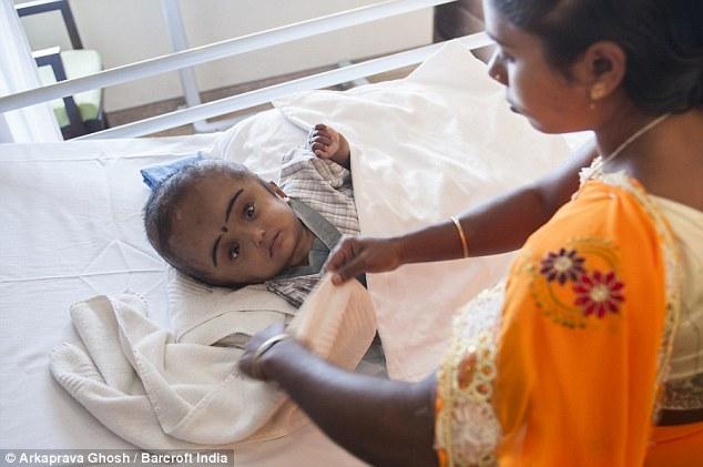 孟加拉两岁男孩患脑积水 头部重18斤