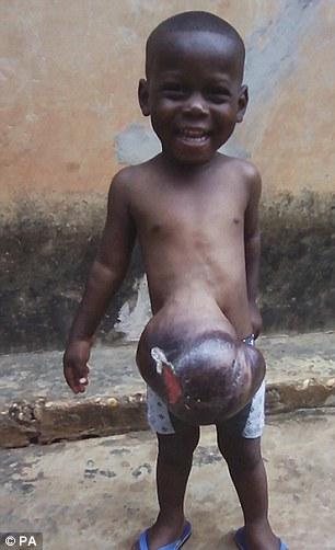 加纳3岁男孩天生脏器长在体外 即将进行救命手术【图】
