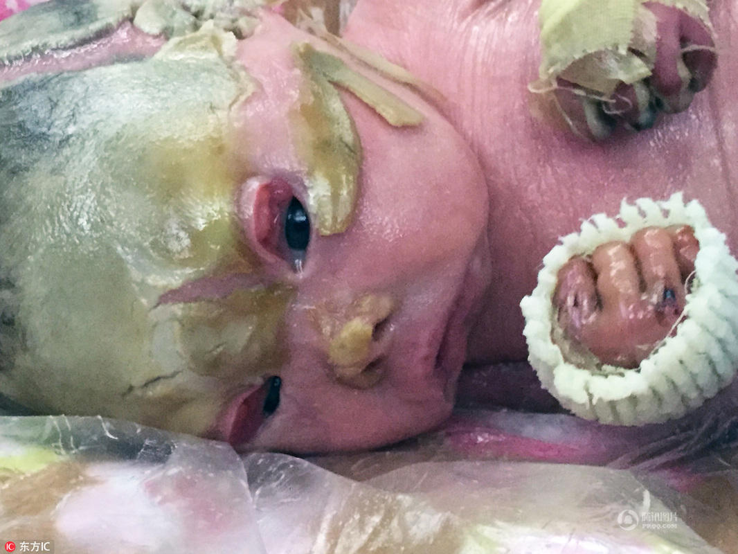 美国婴儿患病全身布满鳞斑顽强求生迎一岁生日