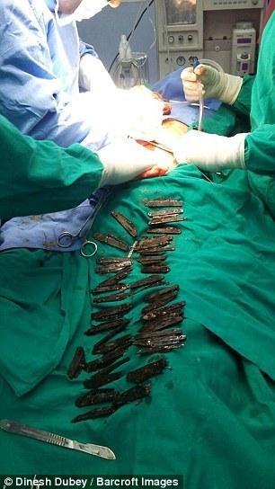 印度男子两个月吞40枚刀片 称迷恋这味道(组图)