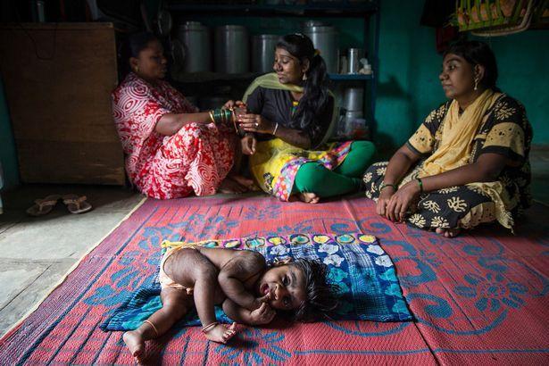 印度5月大男宝继承家族"狼人"基因 浑身是毛(图)