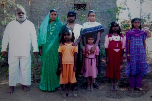 印度5月大男宝继承家族"狼人"基因 浑身是毛(图)