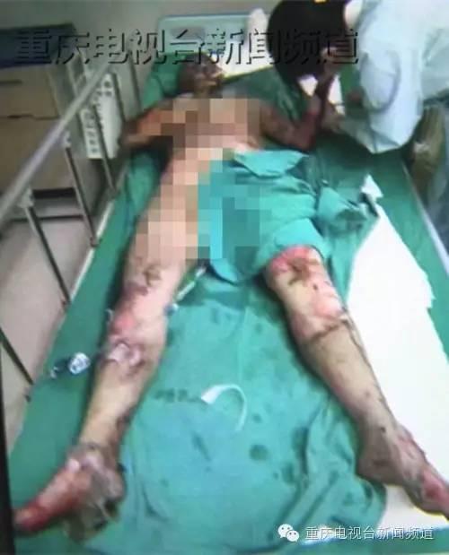 14岁少女为救父亲返回火场 全身烧伤面积达79% - AcFun弹幕视频网 - 认真你就输啦 (ω)ノ- ( ゜- ゜)つロ