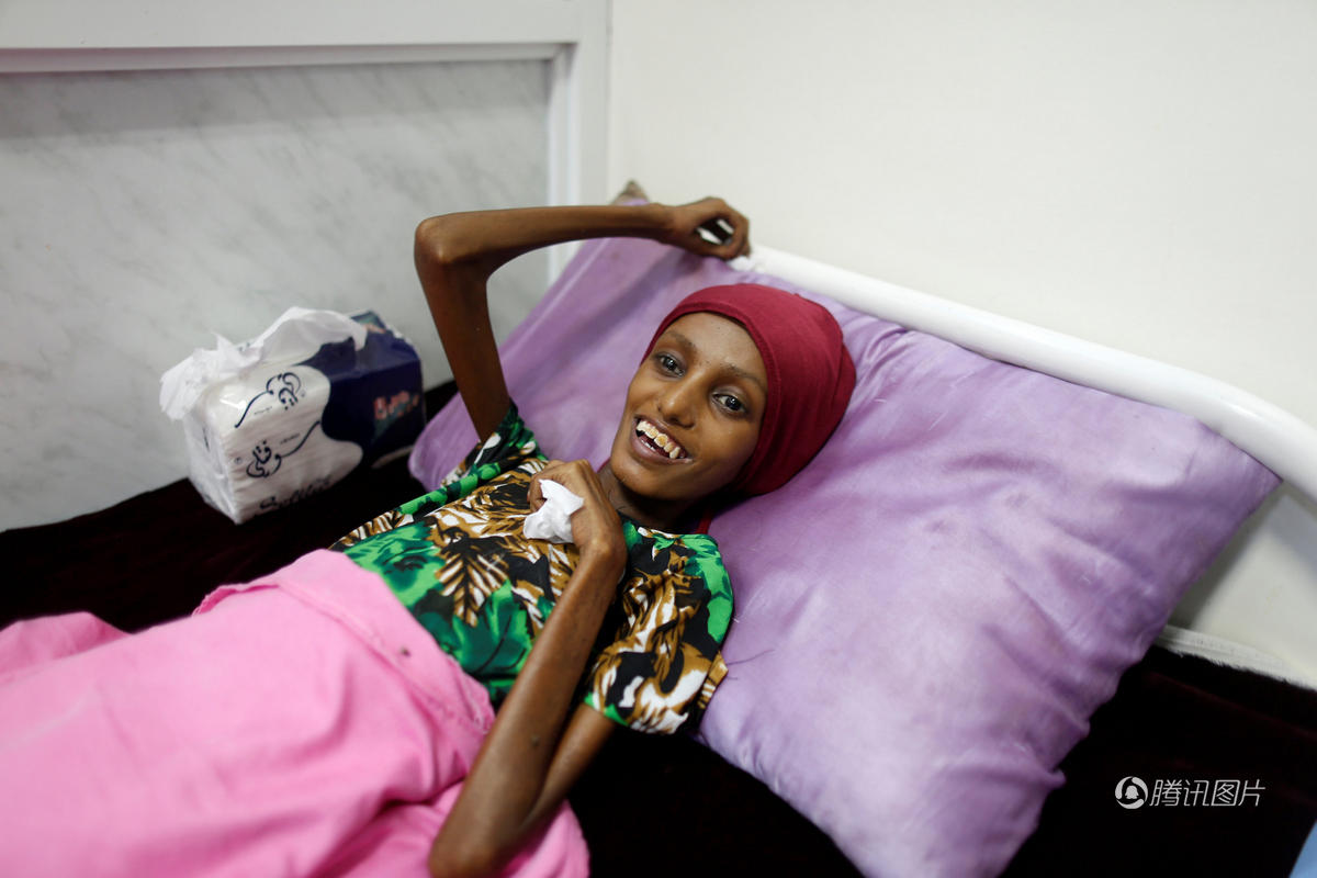 18岁少女营养不良瘦成干尸状 被救治后恢复容颜