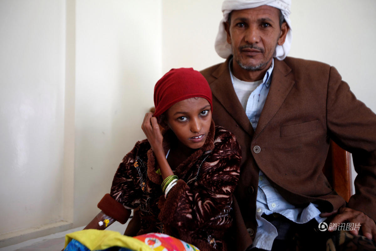 18岁少女营养不良瘦成干尸状 被救治后恢复容颜