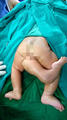  Female infant with "third leg" removed