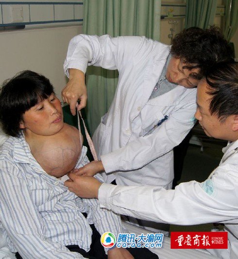 农妇颈 肿瘤 大如篮球 儿女读书中午没钱吃饭_大