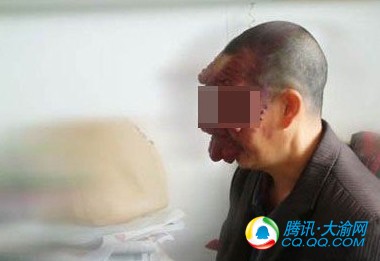 重庆男子面部巨大血管瘤 医院成功换脸