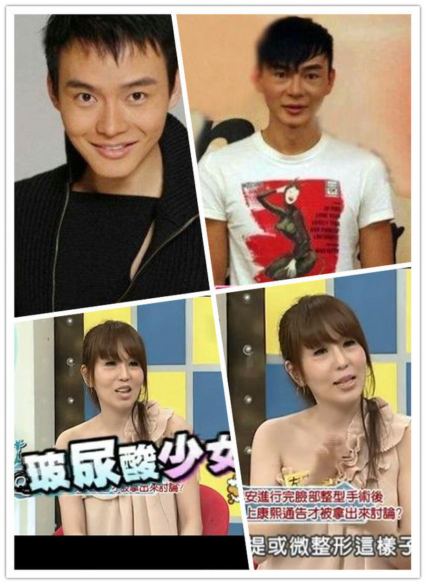  林志玲是不是 打了玻尿酸,脸变肿了,整张脸确实