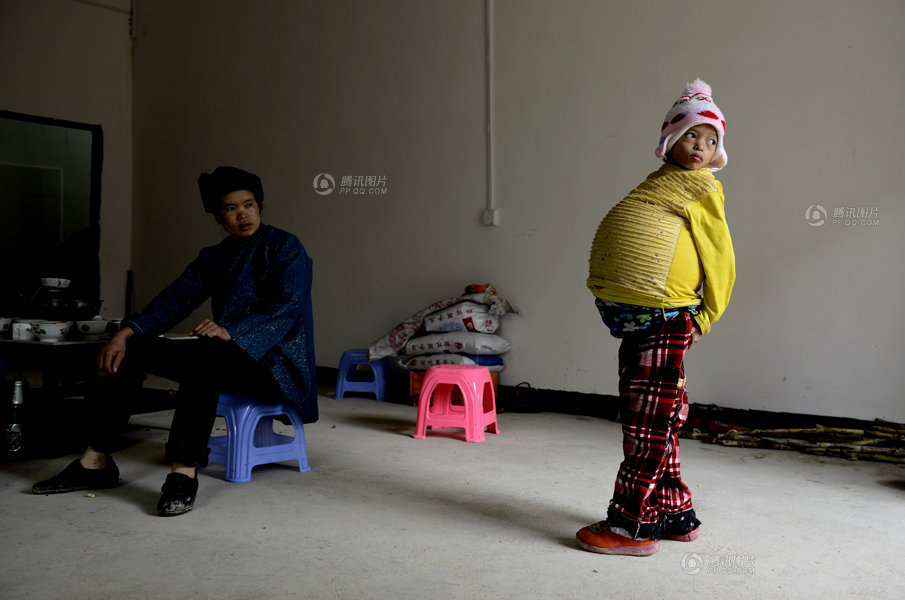 12岁女孩怪病缠身+肚大如孕妇