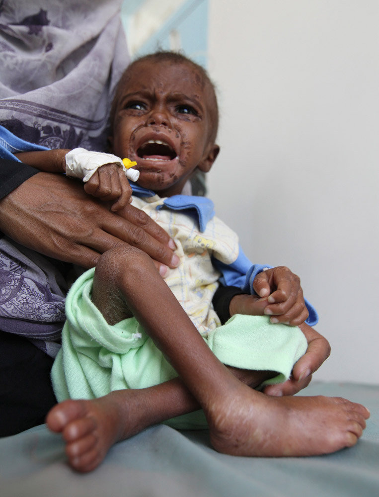 高清:也门近百万儿童遭受营养不良
