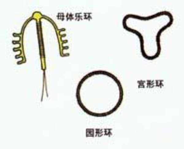 揭秘女性上环全过程
