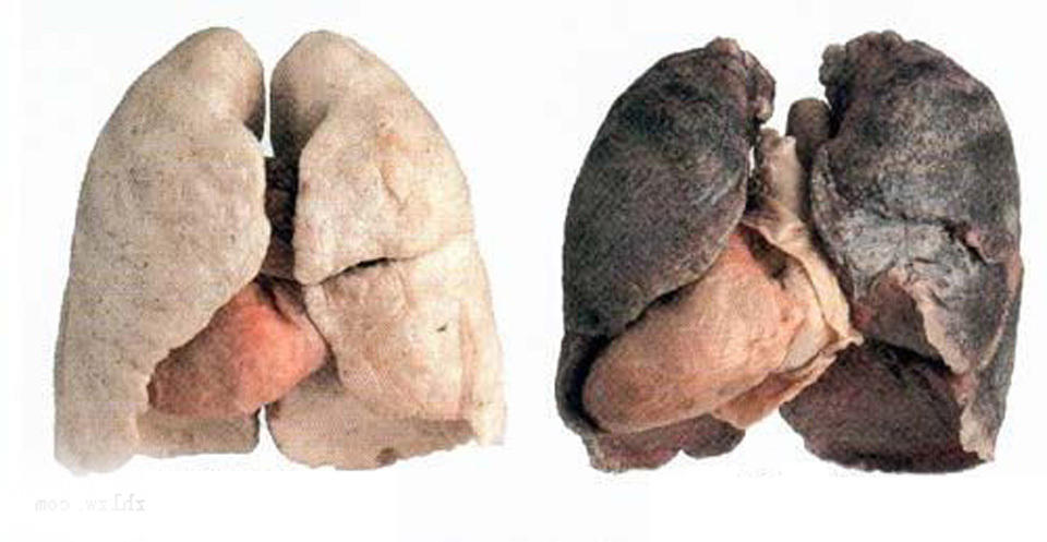 组图:吸烟有害健康 看看吸烟人的肺!