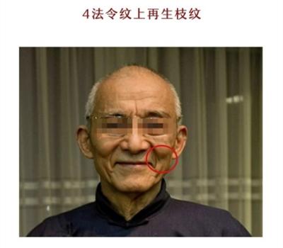 这四种法令纹你有吗