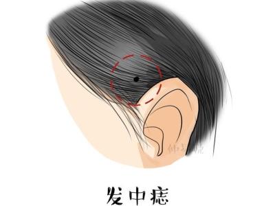 耳垂三痣 148898491.jpg