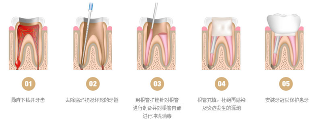 不痛的烂牙更严重