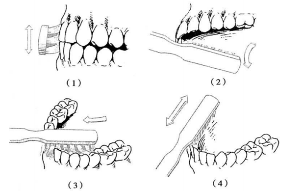 刷不好牙的恶果--楔状缺损_大燕网北京站_腾讯网