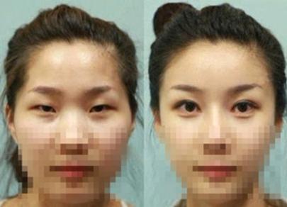 眼睛太小?图解双眼皮整形方法大攻略