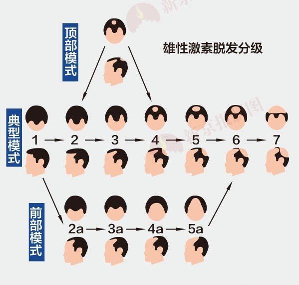 谁偷走了男人们浓密的头发?表情包网红韩国图片