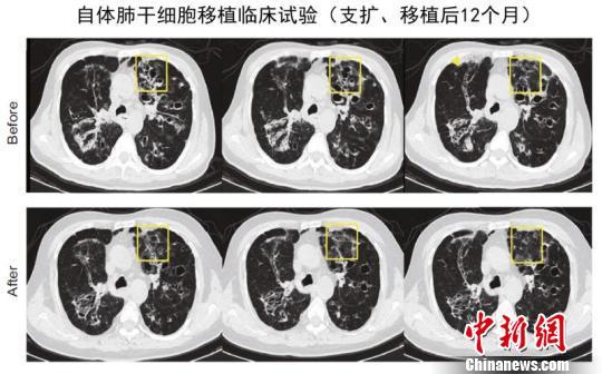 同济大学研究团队实现全球首例人类肺脏再生