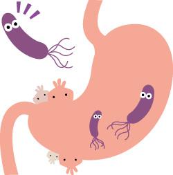 感染幽门螺杆菌潜伏期长 除幽防胃癌举足轻重