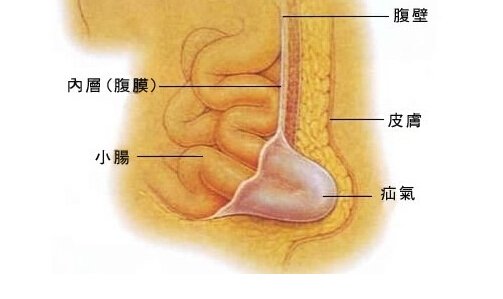 健康课堂06期:勿以疝小而不为