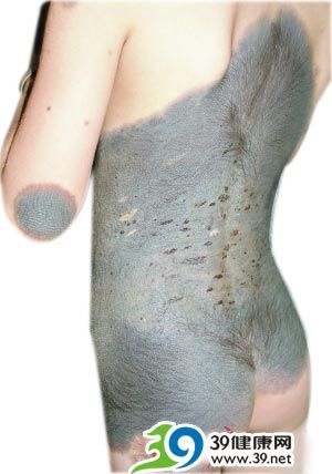 6岁女童背部长满野猪皮_育儿知识