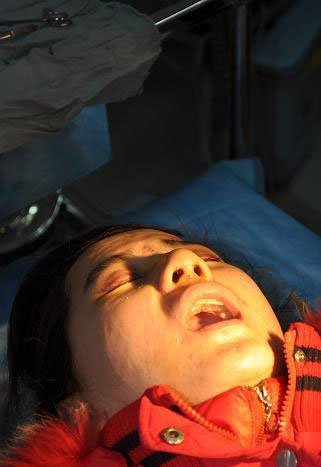 成都女大学生网上大胆自曝血腥整容全程(图)_