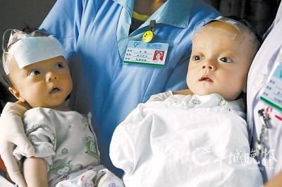 双胞胎兄弟因患脑积水被父母遗弃医院