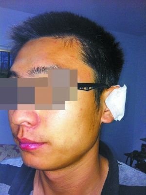 少年理发时耳朵被剪掉 整形花费1600元(图)