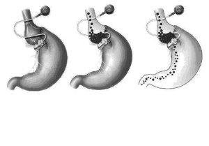 肥胖小伙缩胃减肥 胃上扎绑带控制食量(图)