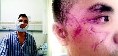帅小伙遇车祸毁容 网友筹近万元为其做手术