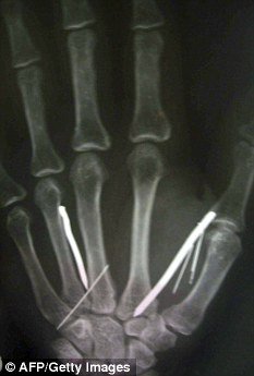 沙特雇主将24根铁钉烧红 插入斯里兰卡女佣体内