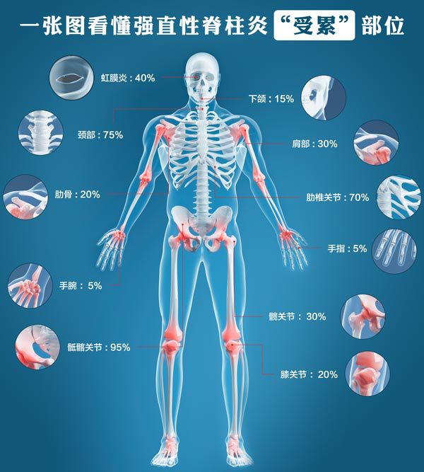 强直性脊柱炎的禁忌