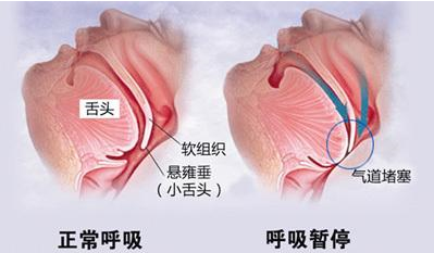 不致命却 要命 得了鼻炎小心大脑缺氧