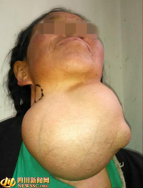 四川老人脖子上长肿瘤 疯长8年后比头还大(图