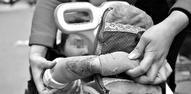 电热水袋爆炸 绵阳6岁女童被严重烫伤(图)