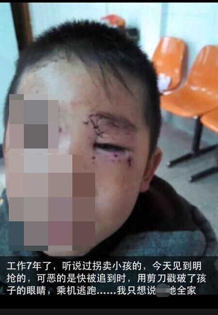 4岁男孩街头被抢 抢人女子逃跑时戳伤孩子眼睛
