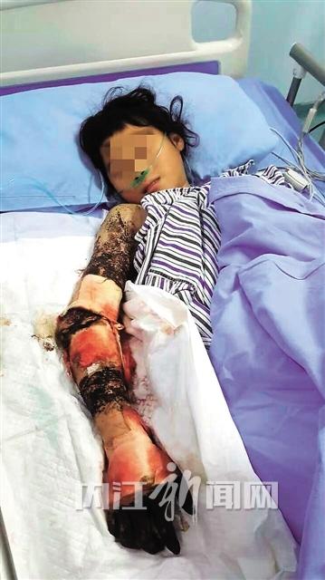 内江12岁小女孩睡梦中被毒蛇咬伤社会捐款33万