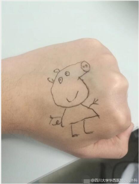 成都儿科医生逗小患者开心 在手背上画小猪佩奇